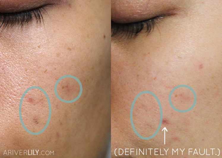 A before and after of the brightening effects of the Freshly Juiced Vitamin Drop on pigmentation (cr. ariverlily)